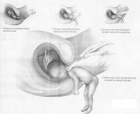 abortion at 8 weeks. Late Term Abortion (a.k.a.